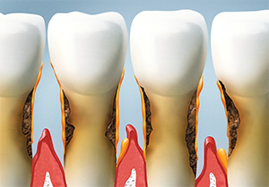Santa Ana  Dentist | gum disease treatment, bleeding gums| Smile Studio
