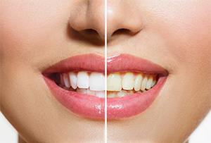 Santa Ana Cosmetic Dentist | teeth whitening, white teeth, stained teeth | Dr. Do